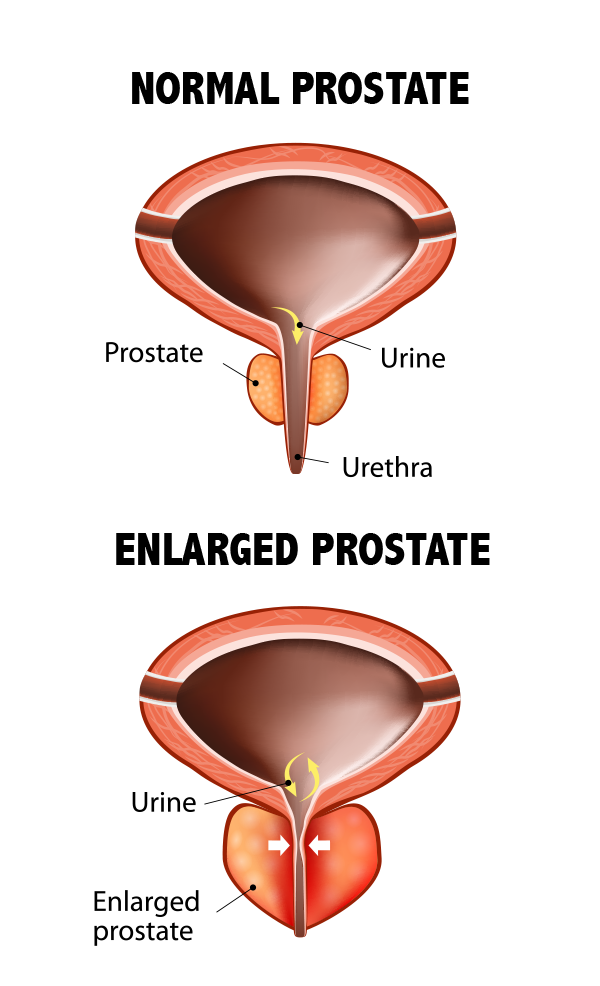 conditions treated, bph, treatment for bph, enlarged prostate, treatment for enlarged prostate