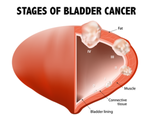 conditions treated, treatment for bladder cancer, bladder cancer